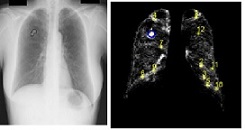 A Solitary Feature-based Lung Nodule Detection Approach for Chest X-Ray Radiographs